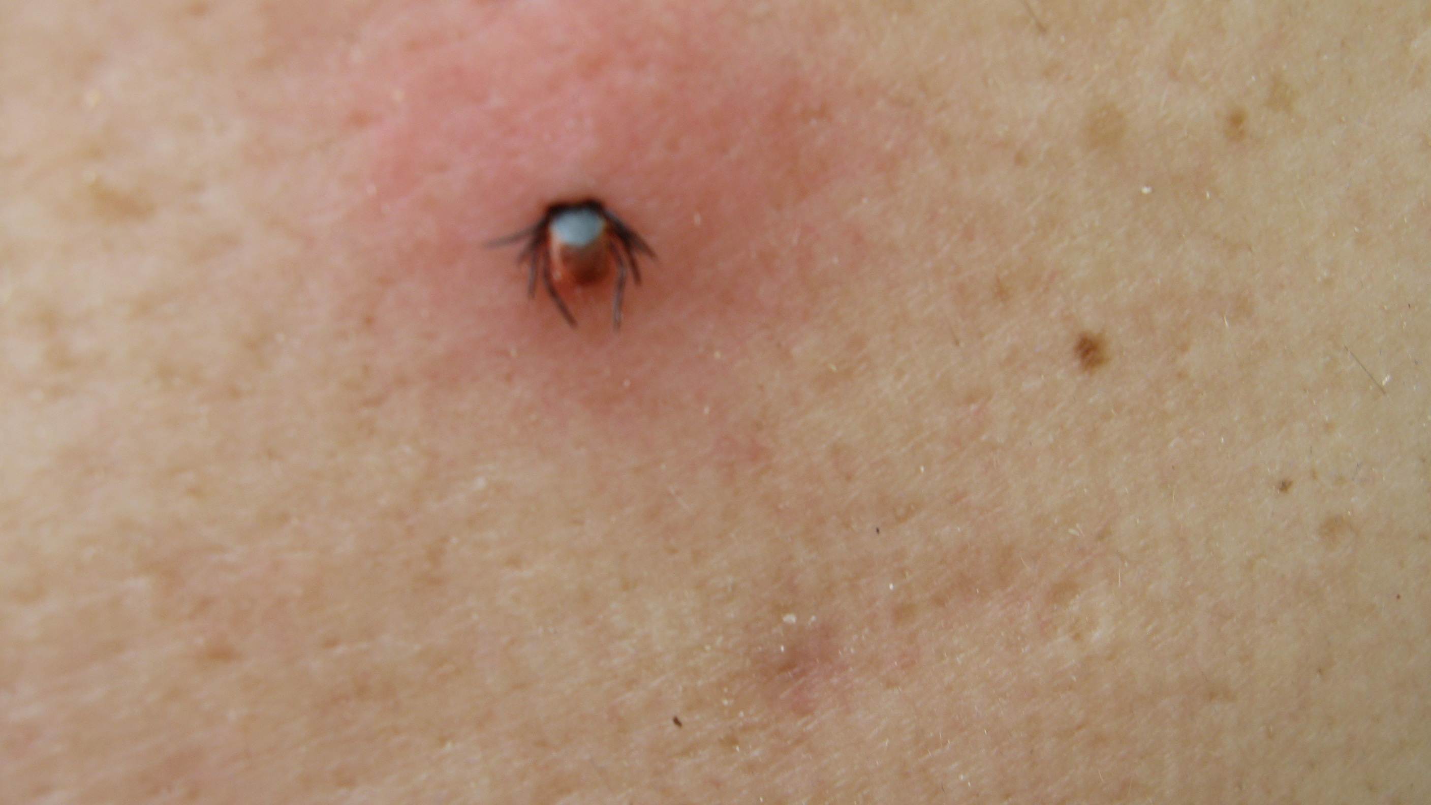 spiacevole sorpresa (puntura di zecca)