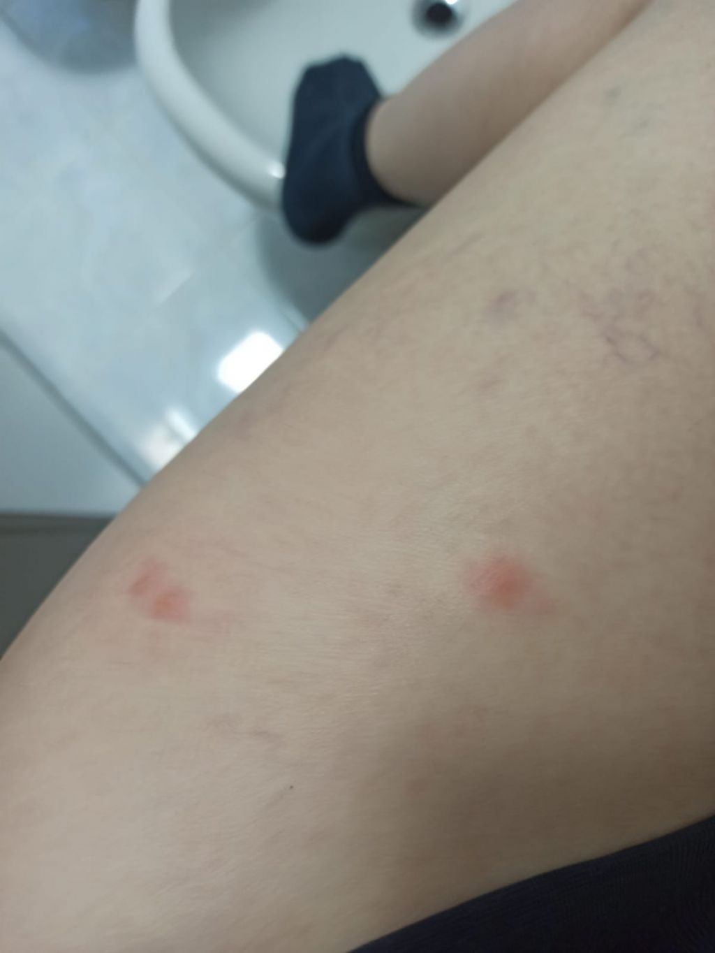 Punture di pulci o cimici del letto?
