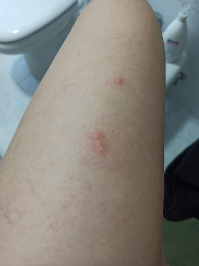 Punture di pulci o cimici del letto?